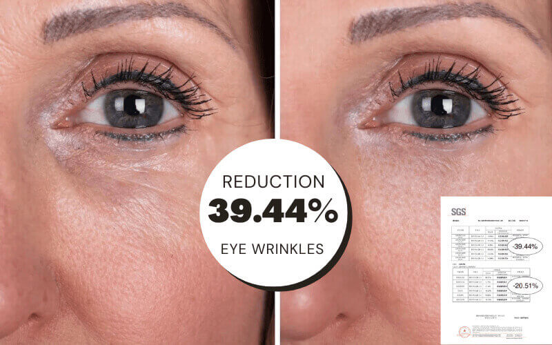 Achieve a 39.44% Reduction in Eye Wrinkles with FITTOP's RF Anti-Aging Device!